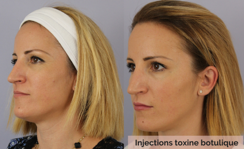 Injections De Toxine Botulique The Beauty Suite Lausanne