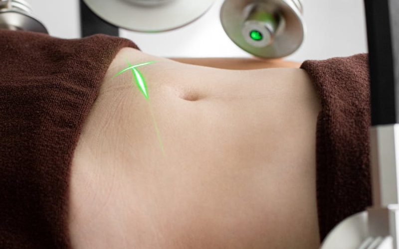 techniques liposuccion