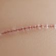 Les cicatrices en chirurgie esthétique : techniques modernes pour les minimiser au maximum