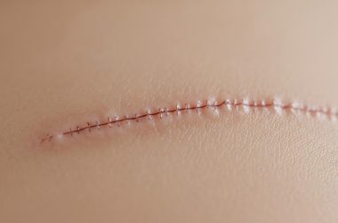 Les cicatrices en chirurgie esthétique : techniques modernes pour les minimiser au maximum