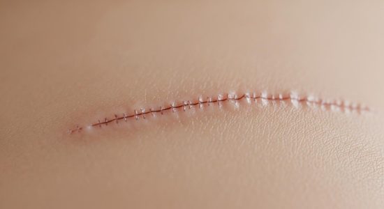 Les cicatrices en chirurgie esthétique : techniques modernes pour les minimiser au maximum