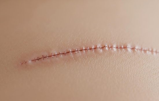 Les cicatrices en chirurgie esthétique : techniques modernes pour les minimiser au maximum