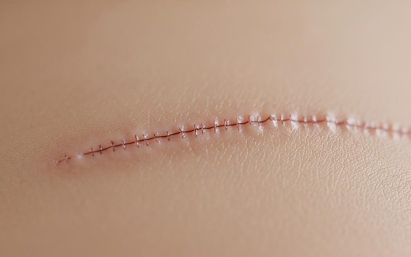 Les cicatrices en chirurgie esthétique : techniques modernes pour les minimiser au maximum