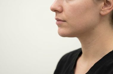 Chirurgie du menton : comment harmoniser le profil du visage durablement
