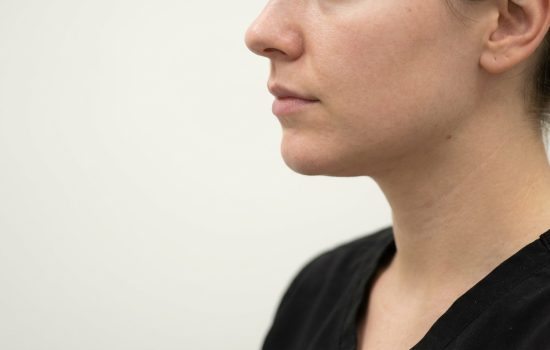 Chirurgie du menton : comment harmoniser le profil du visage durablement