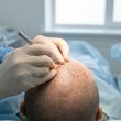 La greffe de cheveux FUE : une technique moderne et discrète pour retrouver une chevelure