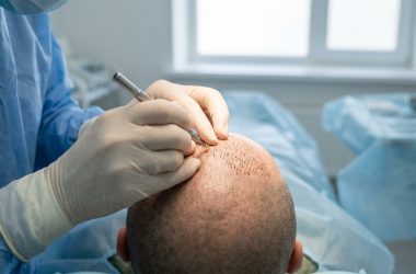 La greffe de cheveux FUE : une technique moderne et discrète pour retrouver une chevelure