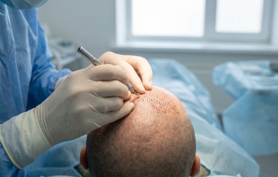 La greffe de cheveux FUE : une technique moderne et discrète pour retrouver une chevelure