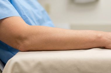 Lifting des bras : comment éliminer l'effet chauve-souris et retrouver des bras toniques