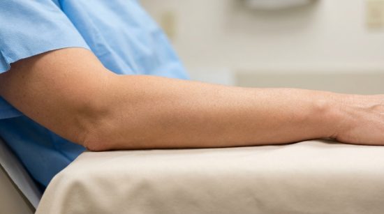 Lifting des bras : comment éliminer l'effet chauve-souris et retrouver des bras toniques