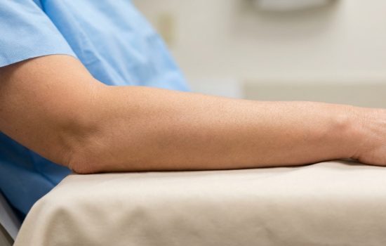 Lifting des bras : comment éliminer l'effet chauve-souris et retrouver des bras toniques