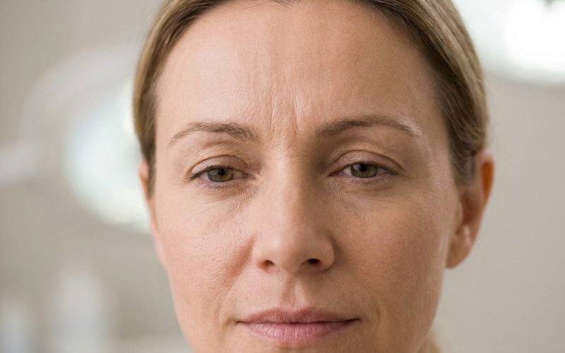 Comment traiter les rides du lion efficacement sans figer les expressions ?