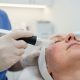 Le laser pour traiter la couperose et les rougeurs : efficacité et déroulement